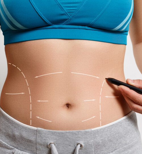 Abdominoplasty (Tummy Tuck)